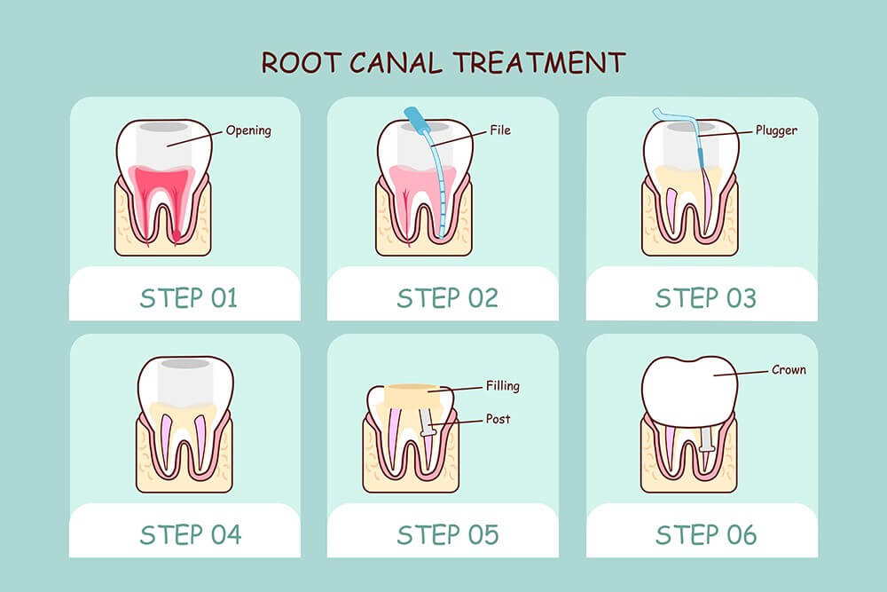 How Safe Is Root Canal