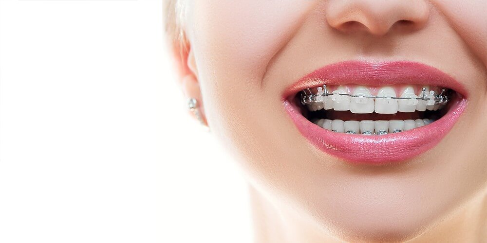 What Are the Best Type of Braces for Your Teeth