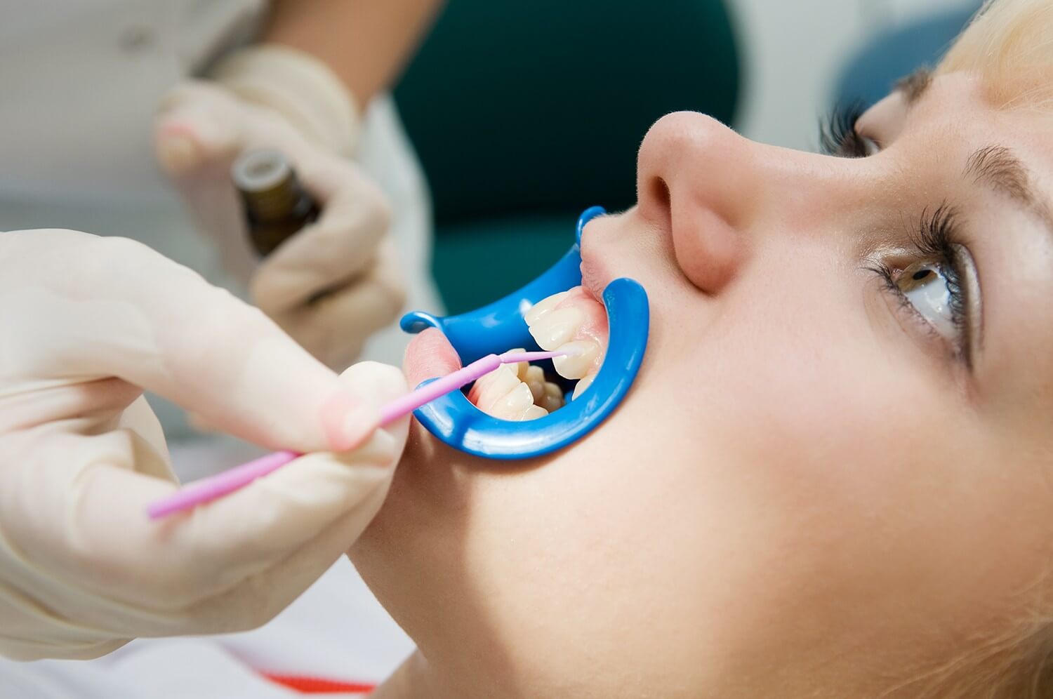 How Sealants Prevent Cavities