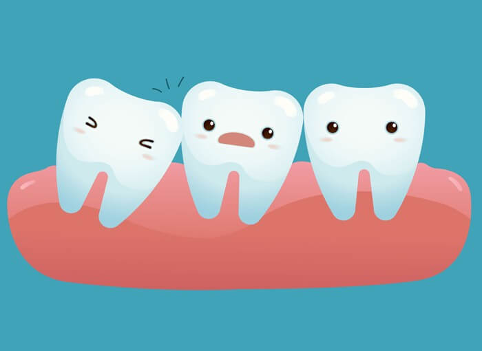What is an Impacted Tooth