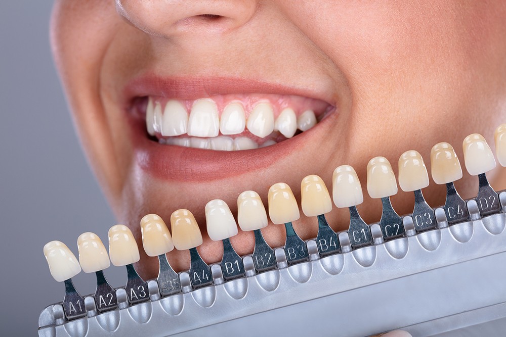 Does Teeth Whitening Works?
