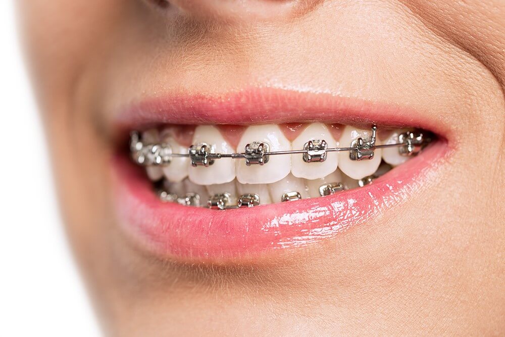 Are Braces Better Than Invisalign?