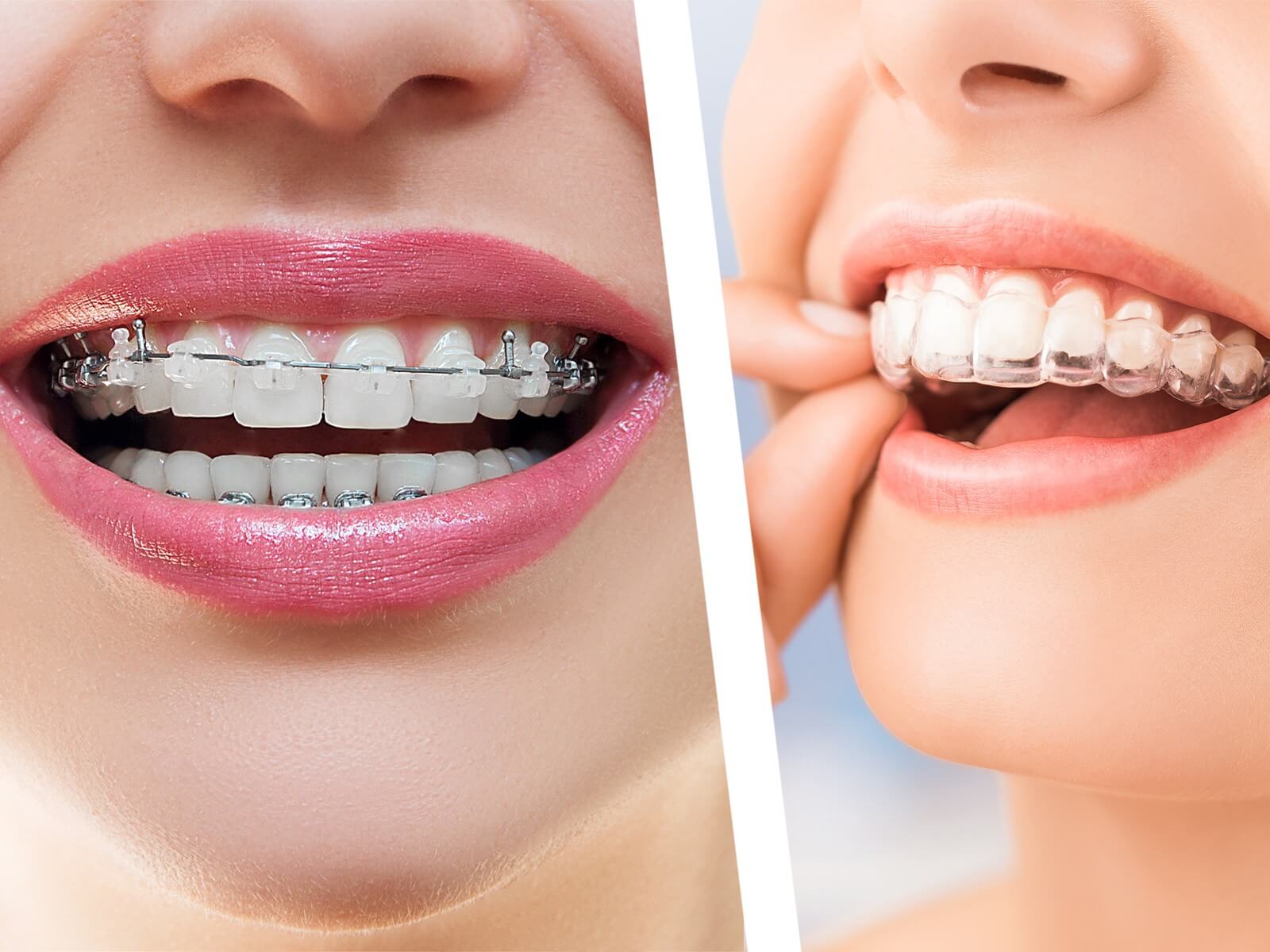 Which one is better: Invisalign or Braces?