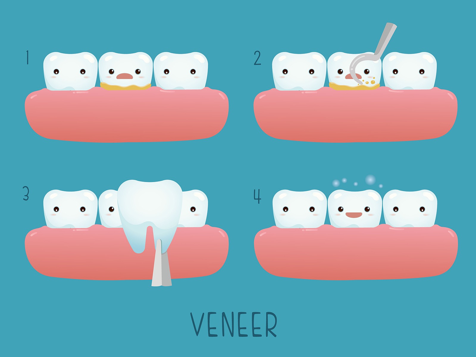 Is Veneer good for me?