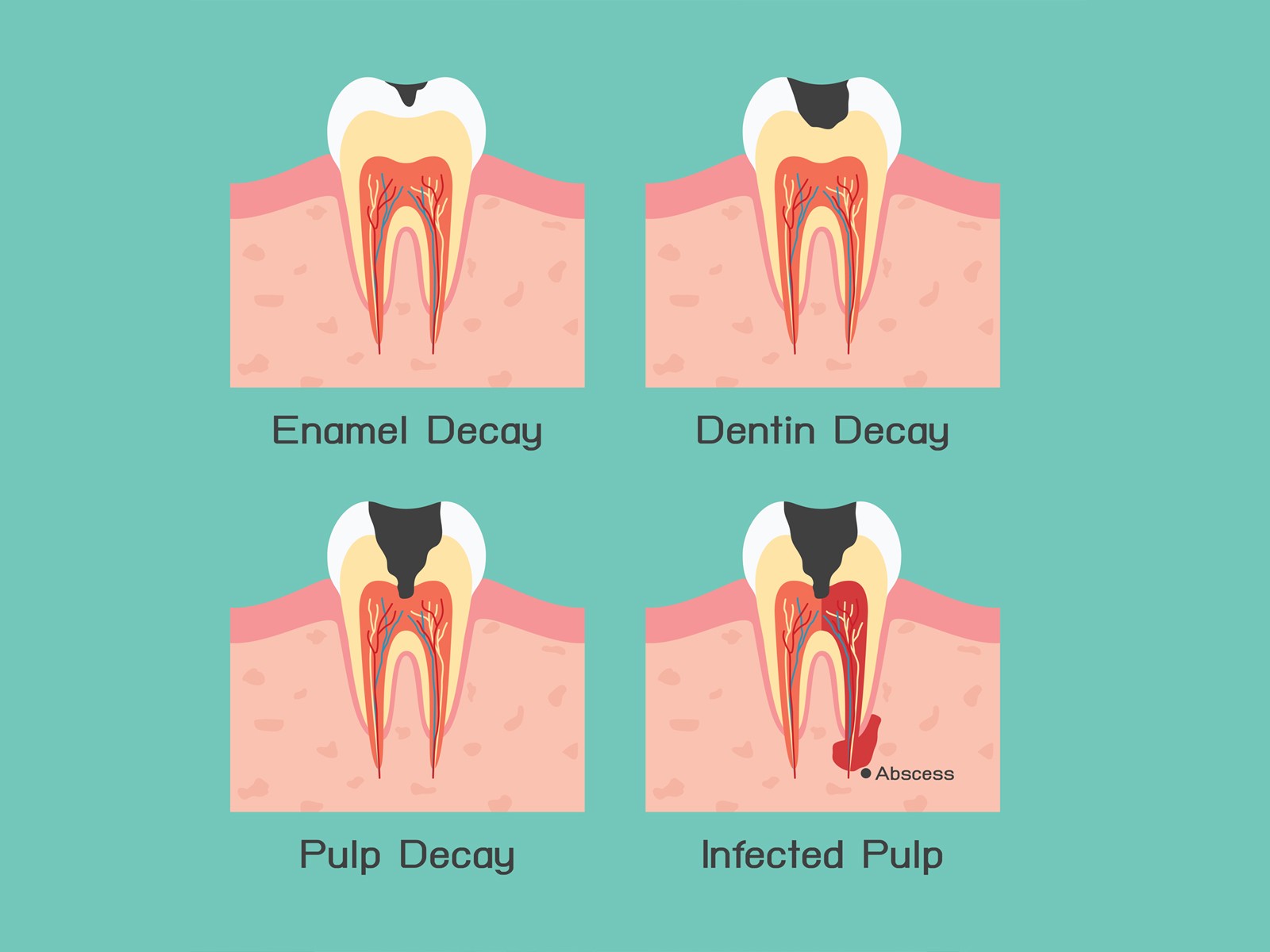 Can root canal stop tooth decay and save your teeth?