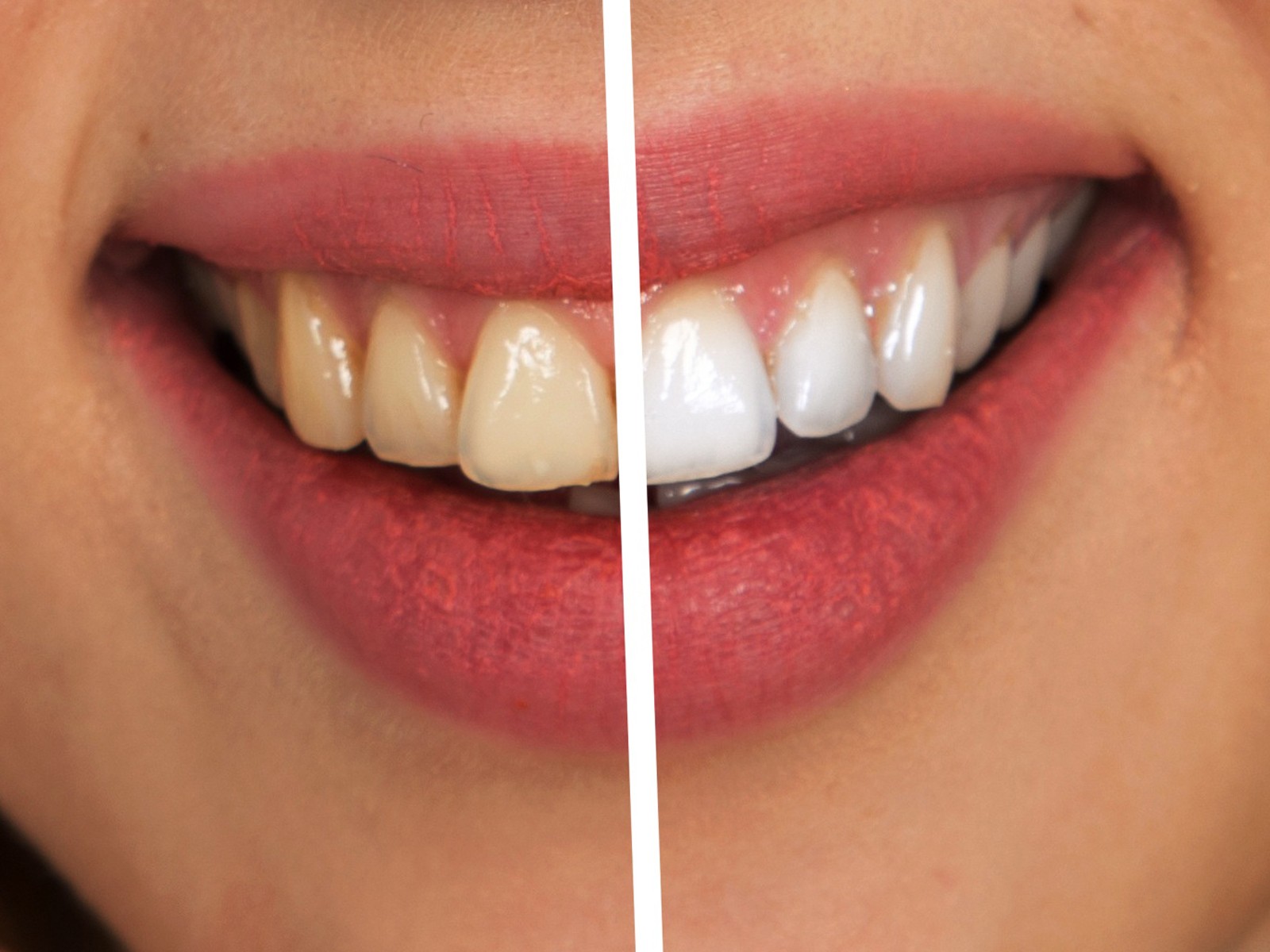 Professional Teeth Whitening vs. Home Teeth Whitening