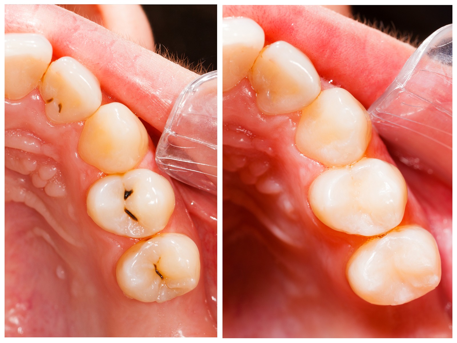 Benefits of Composite Resin Fillings