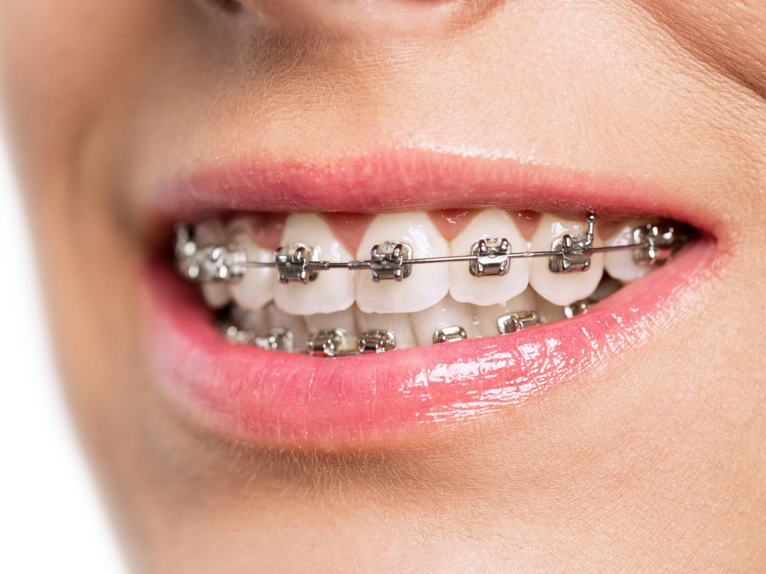 How to correct deep bite with braces?