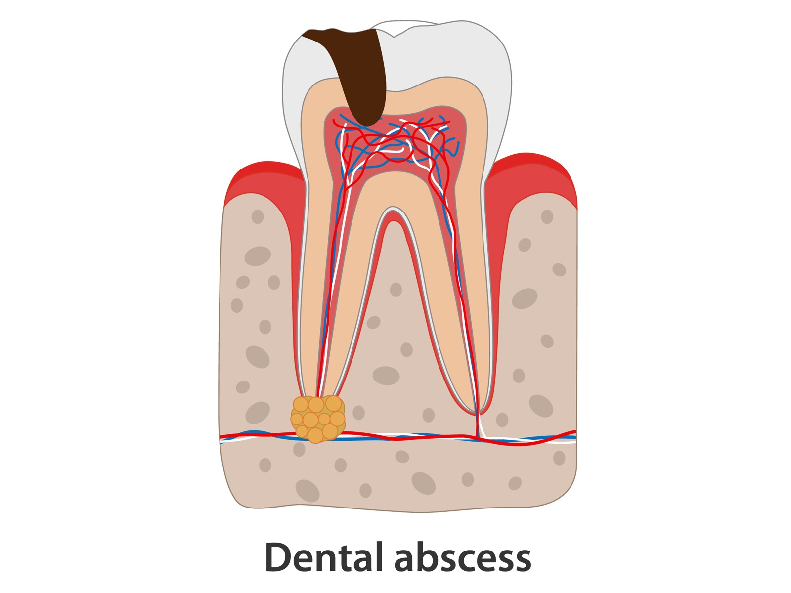 Can dental abscess go away on its own?