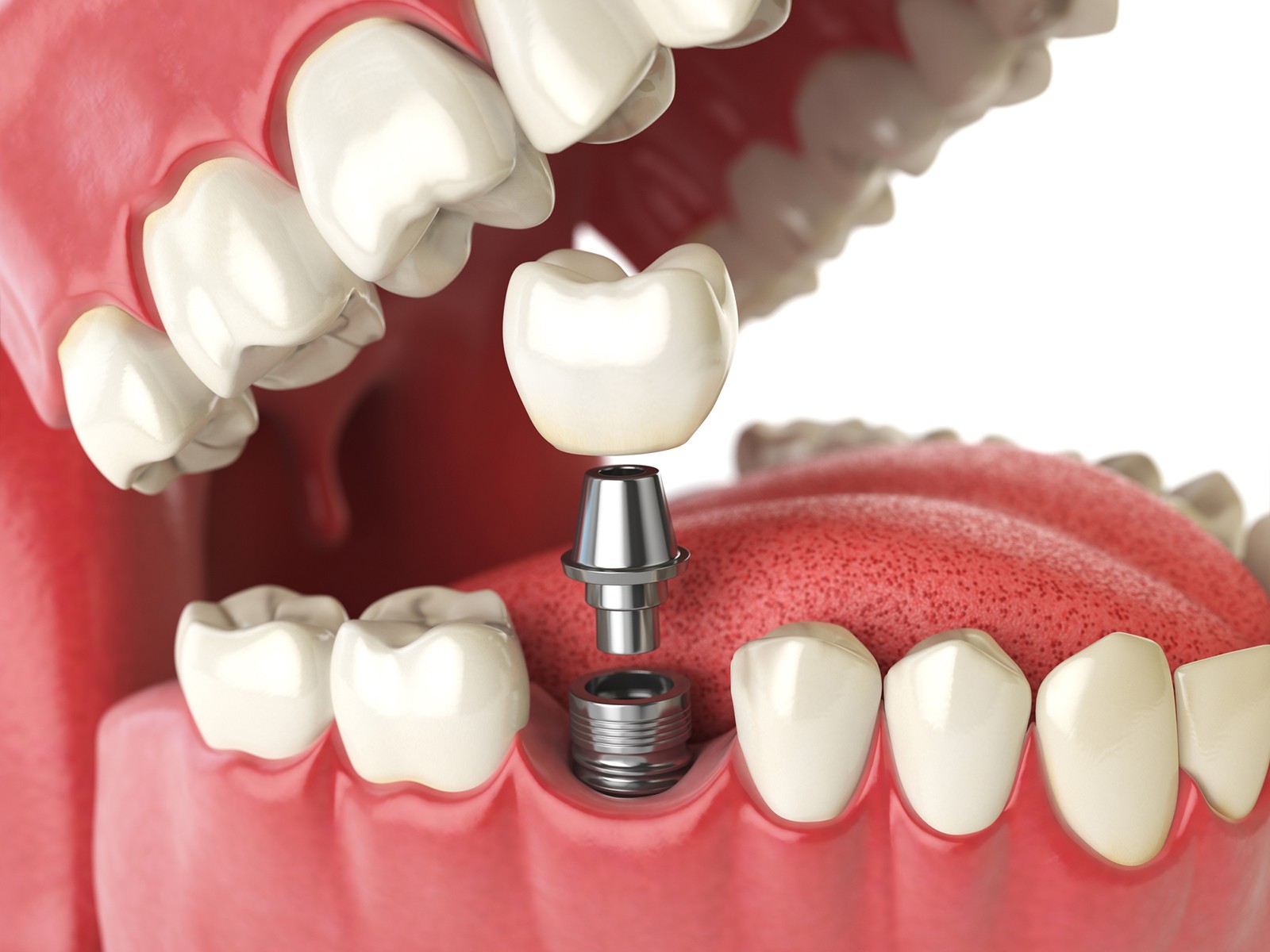 Are dental implants painful?