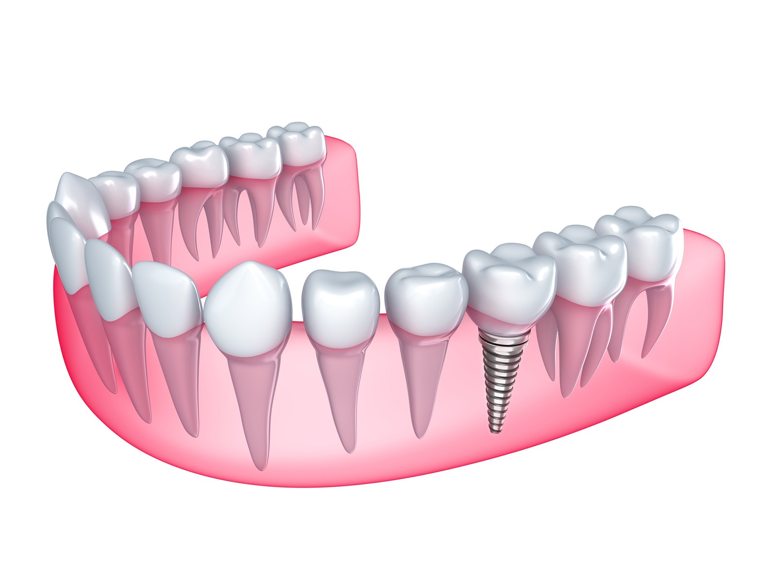 How can I get help paying for dental implants?