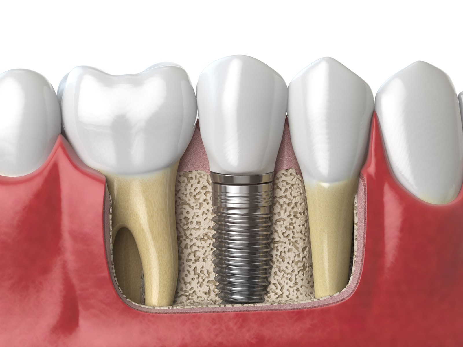 Is Alcohol Bad for Dental Implants?