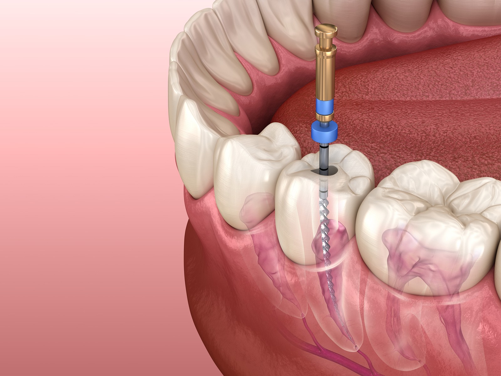 Can a Root Canal Affect Your Brain?