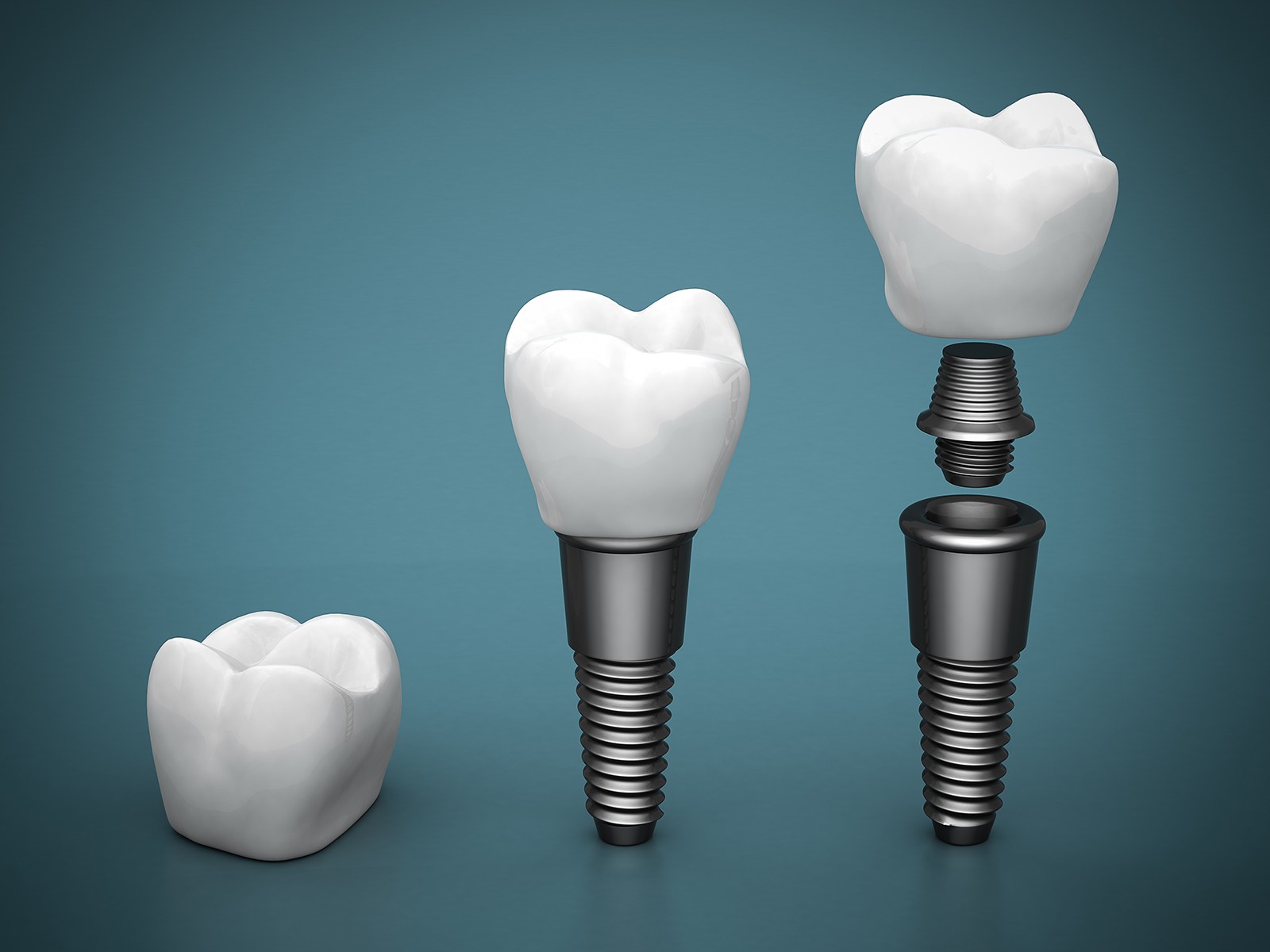 How long does it take to place an abutment?