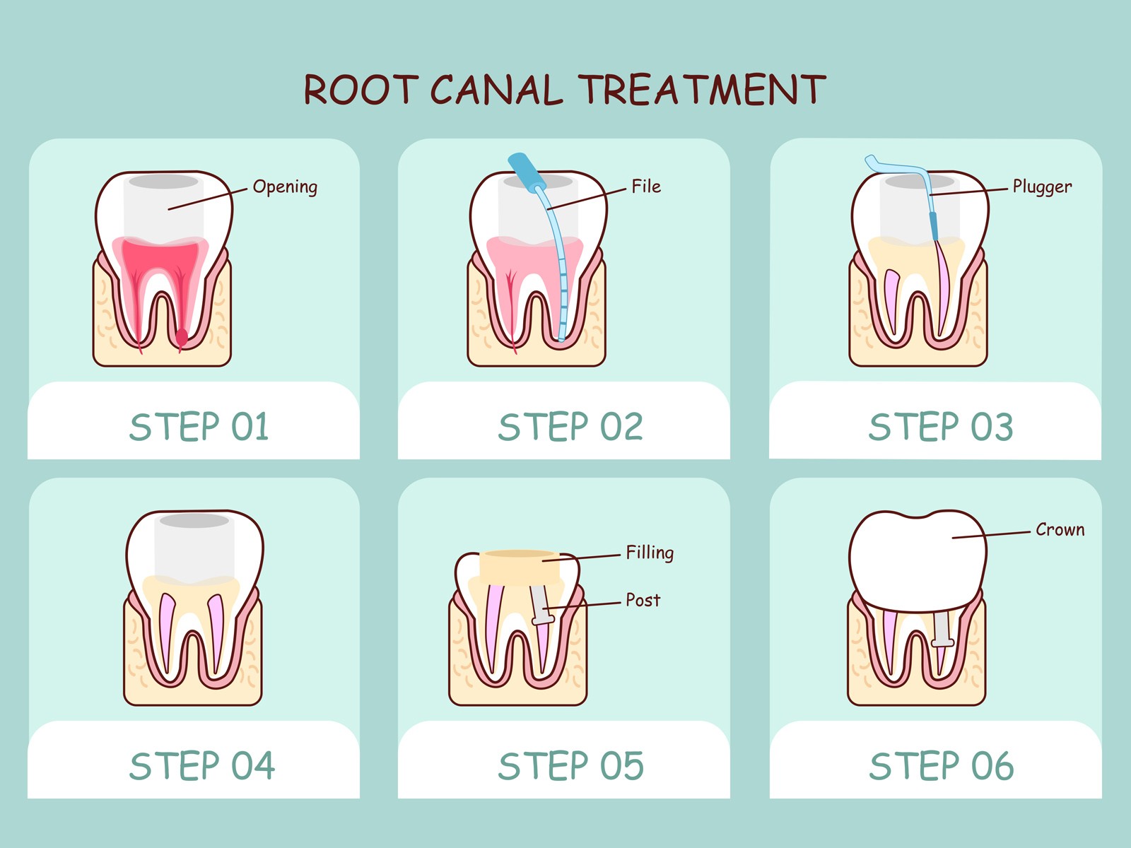 Do I Need Antibiotics after Root Canal?