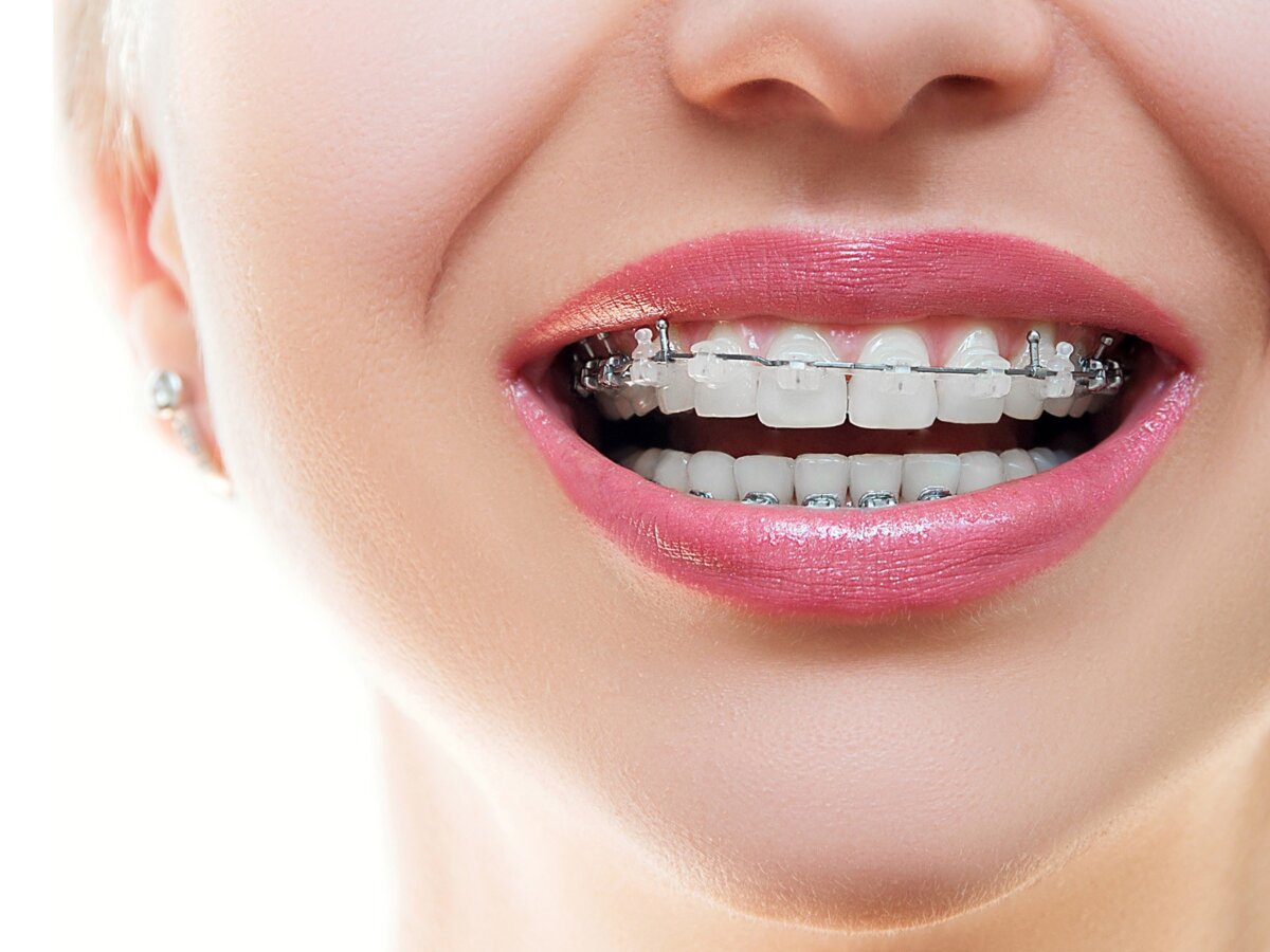 What Are Orthodontic Elastics (Rubber Bands) And How Do They Work?