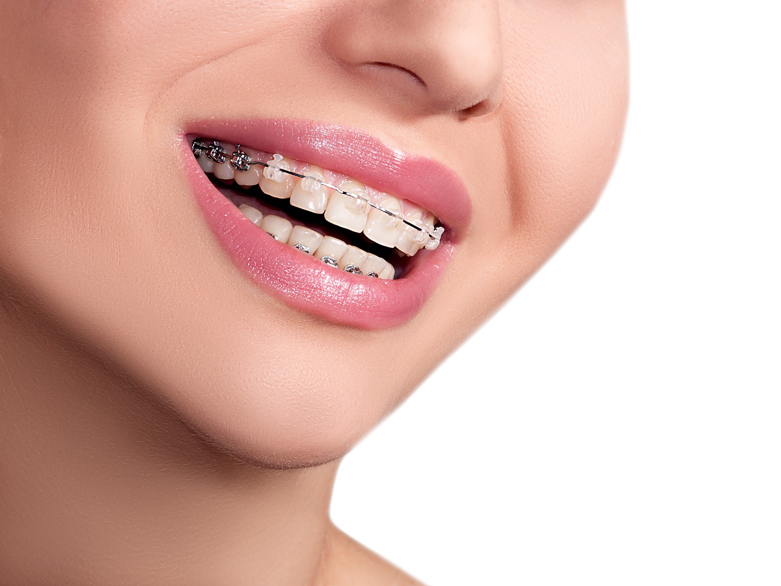What are the pros and cons of having braces?