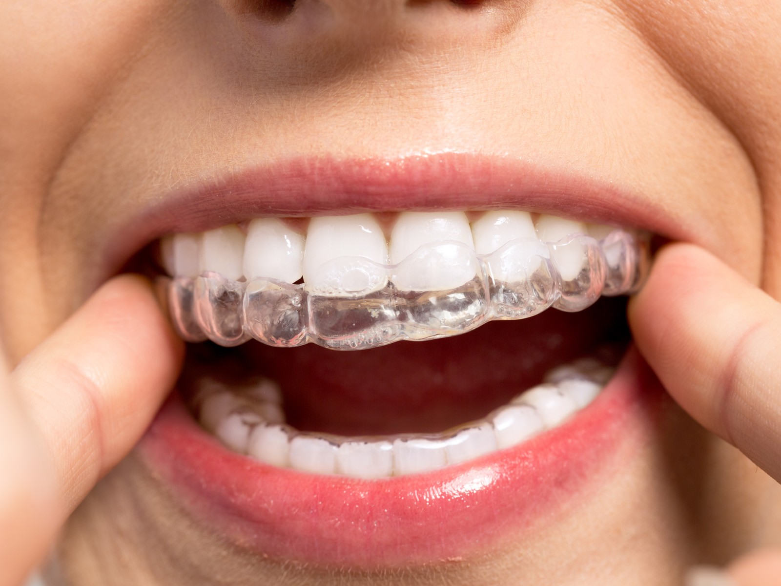 Can I Get a Permanent Retainer After Invisalign?