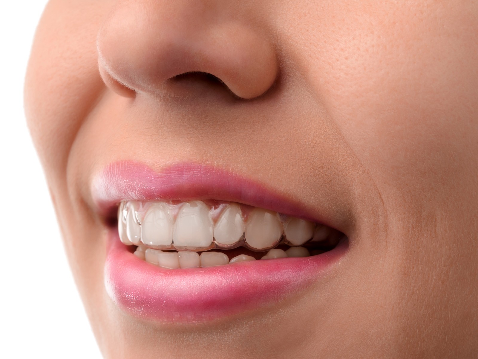 Does Invisalign make you talk funny?