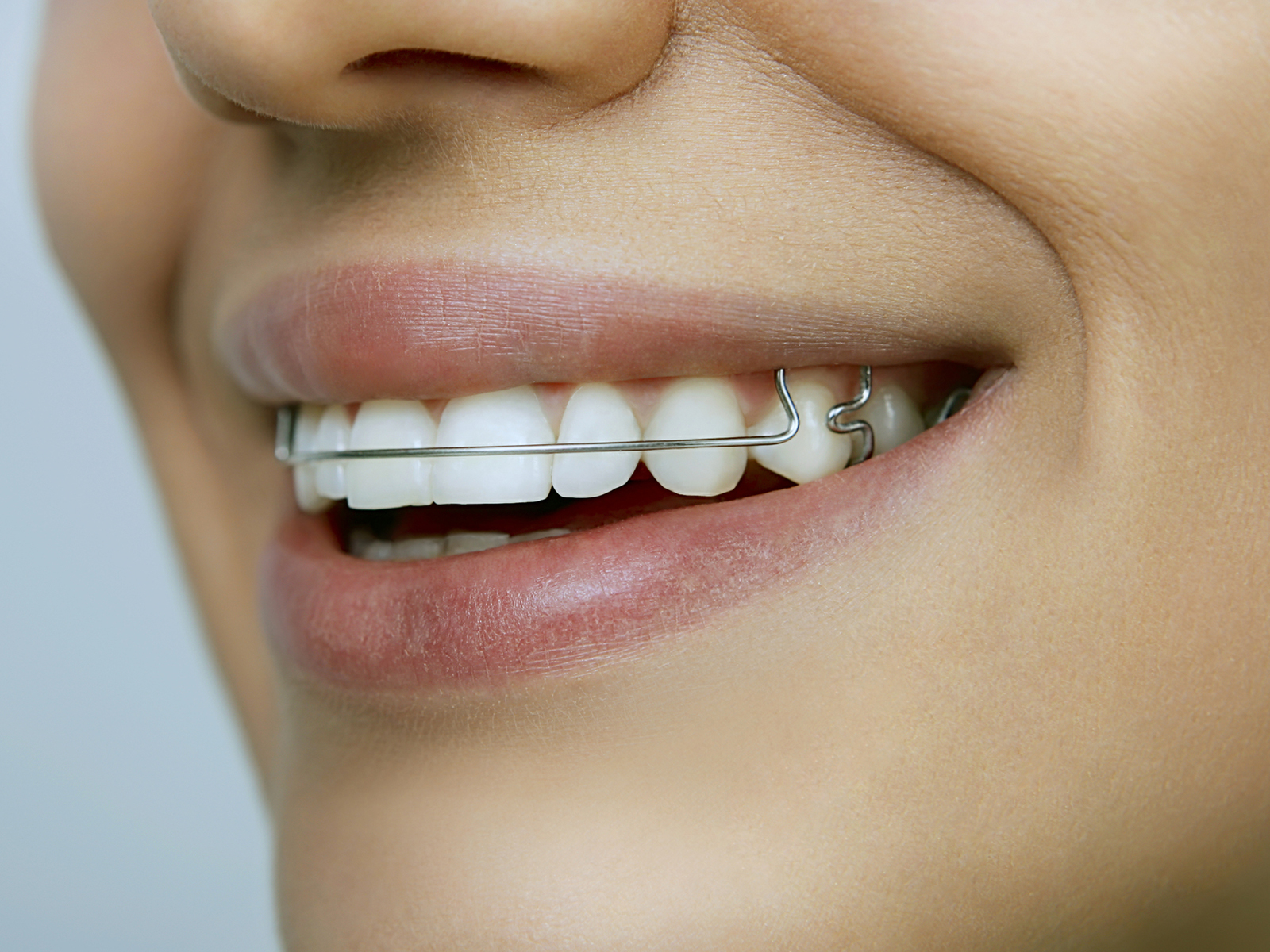 Can wearing retainers move teeth back?