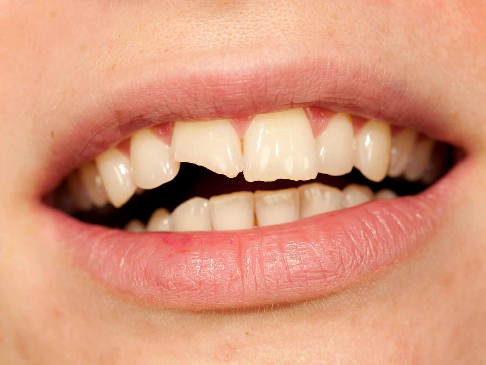 Self-Care Tips For Your Chipped or Broken Tooth