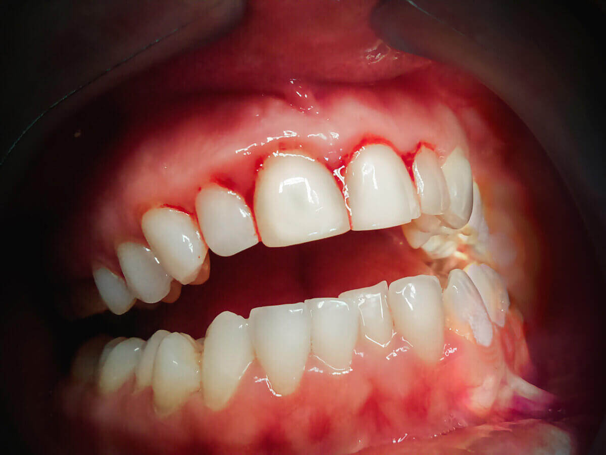 How Do You Fix Bleeding Gums When Flossing?