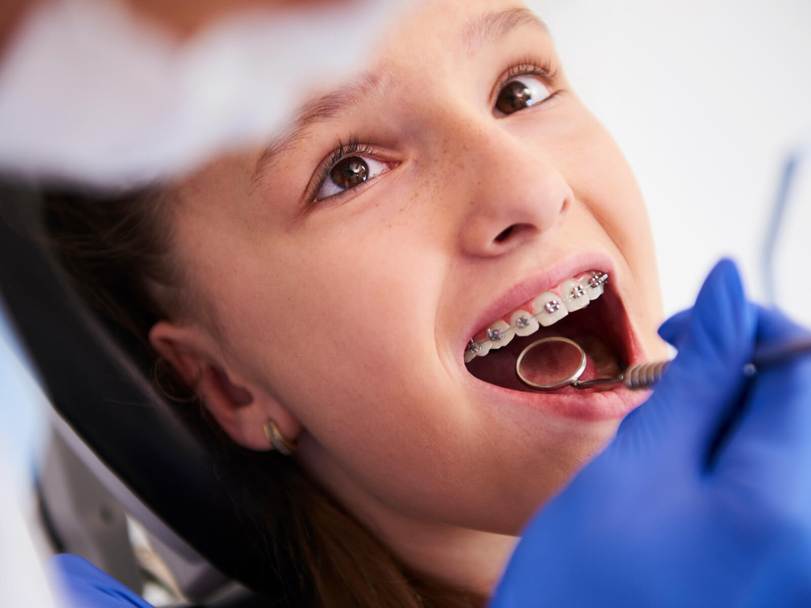 How Do Orthodontists Fix Buck Teeth?
