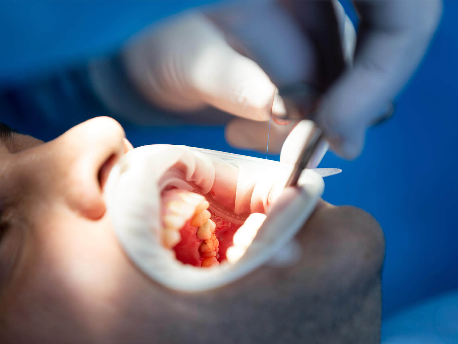 Does Medicare Cover Dental Implant Surgery?