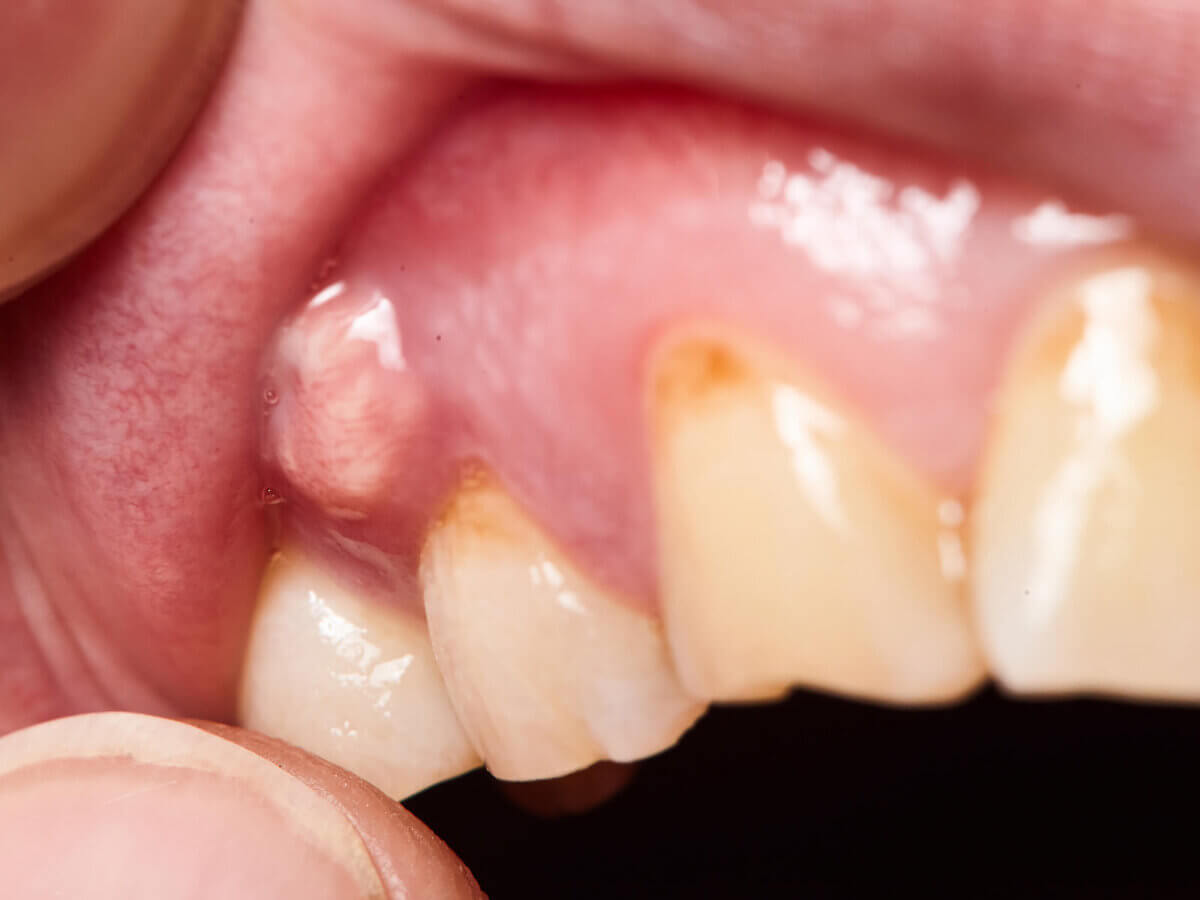 Tooth Abscess