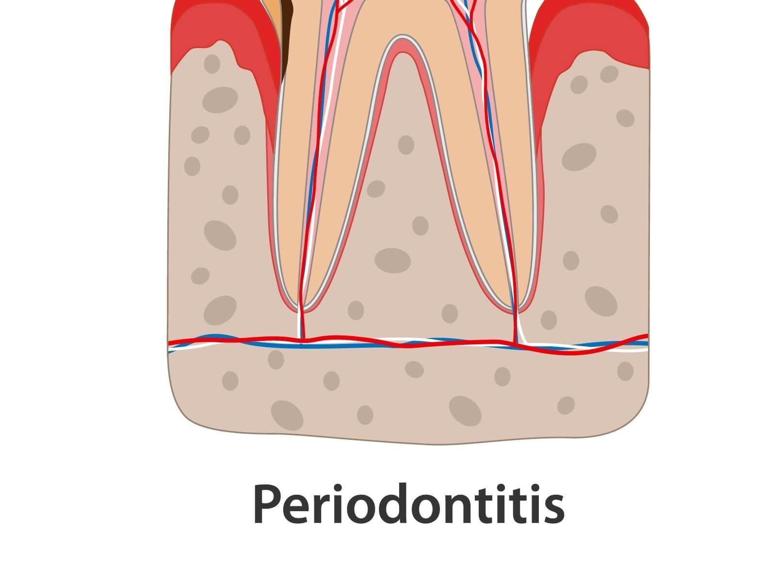 How To Reverse Gingivitis Before It Turns Into Periodontitis