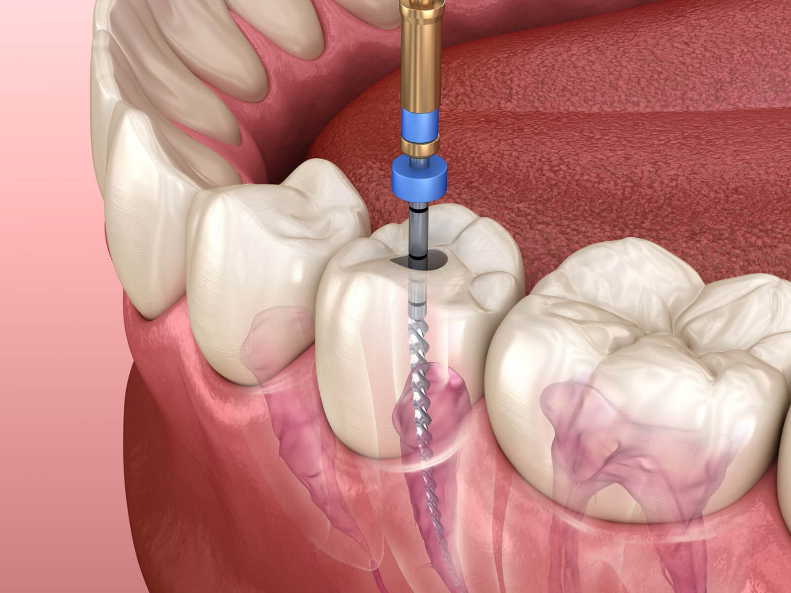 Signs You May Need A Root Canal And What To Expect