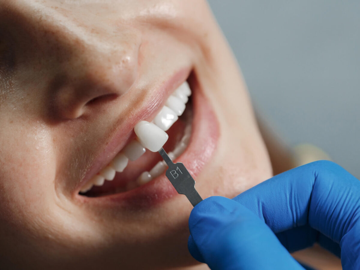 Crowns Vs. Fillings: Which Dental Restoration Do You Need?