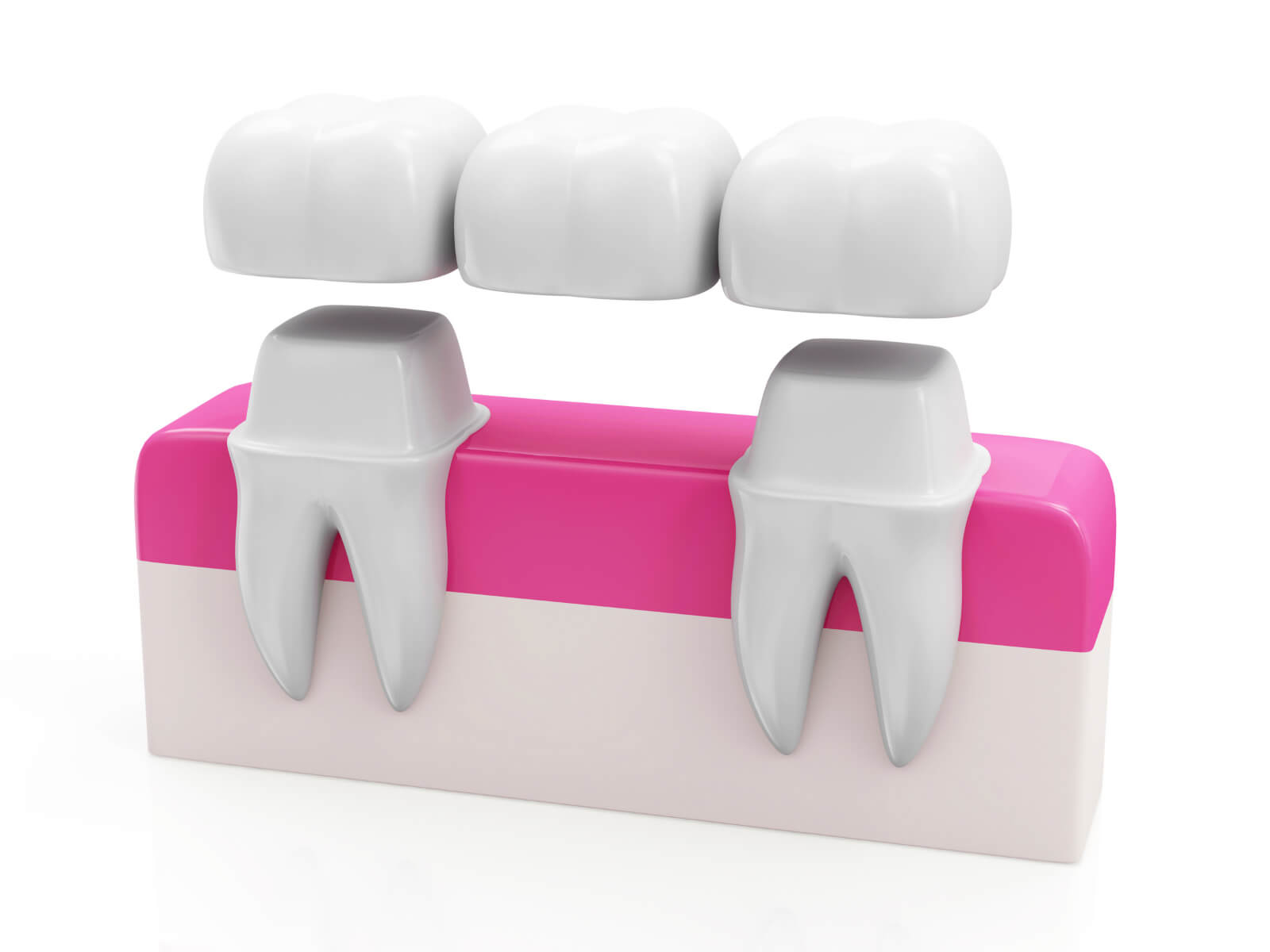 The Pros and Cons of a Dental Bridge