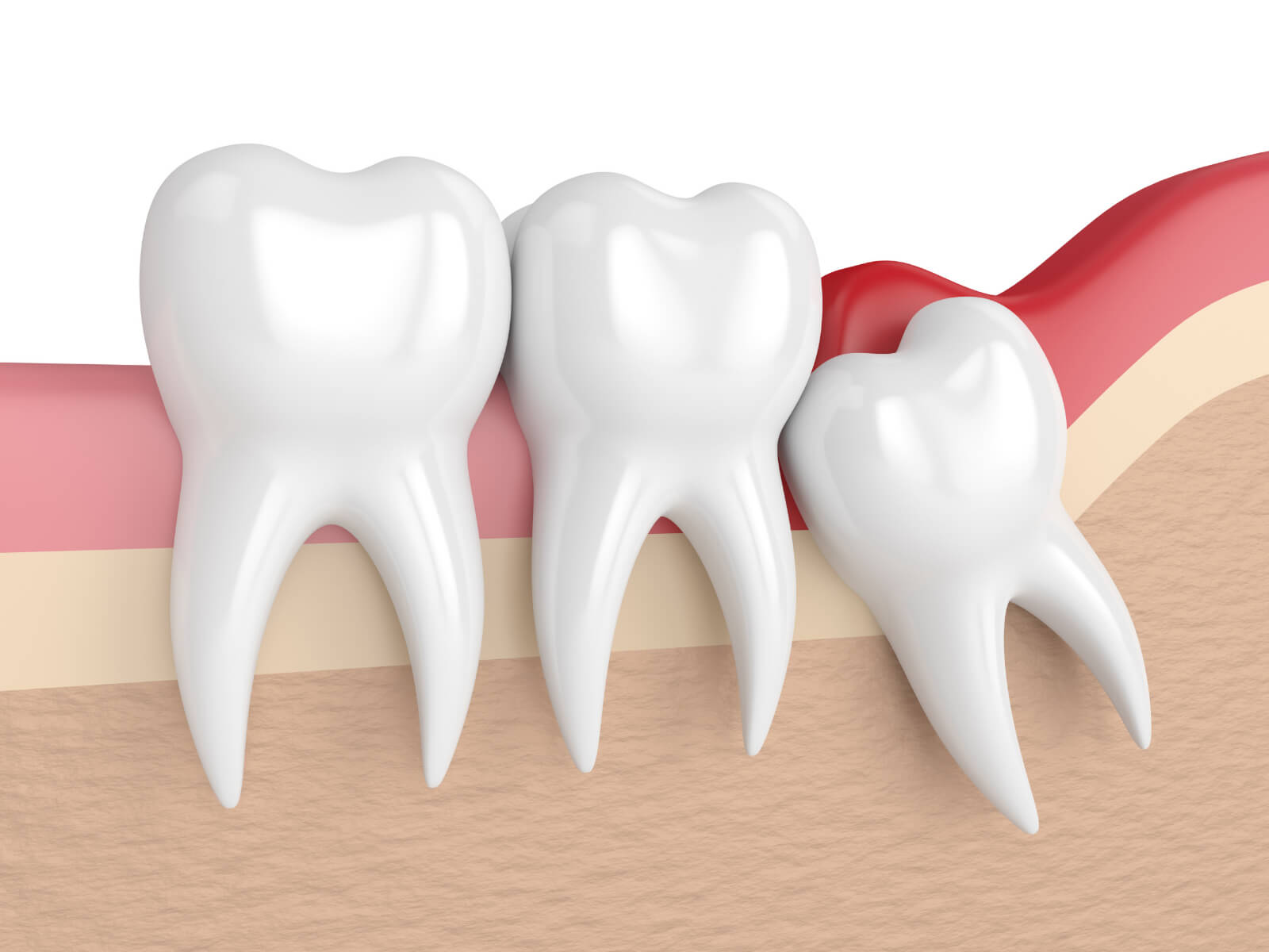 Wisdom Tooth Removal: When It’s Necessary And What To Expect