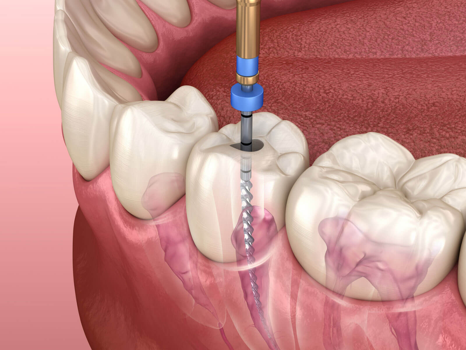 How Long Does It Take To Recover From A Root Canal?