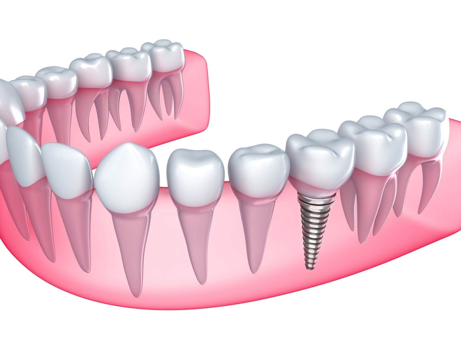 Top 6 Reasons To Choose Dental Implants For Missing Teeth