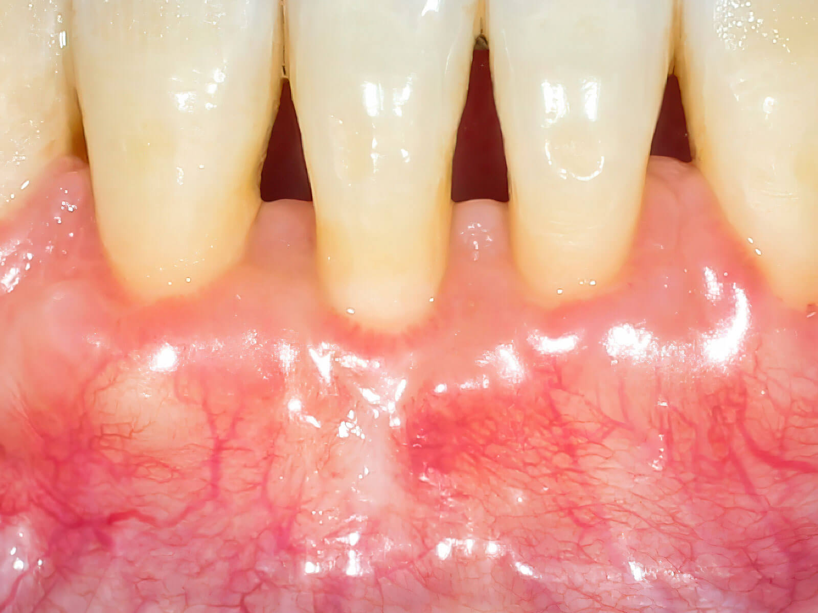 Does Dental Cleaning Damage Enamel?