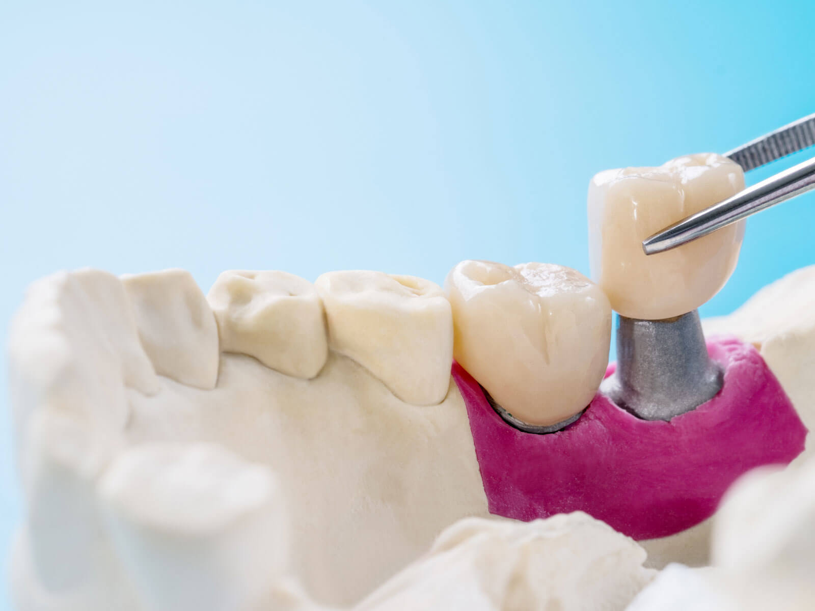 Types of Dental Crowns: Materials, Benefits, and Procedure