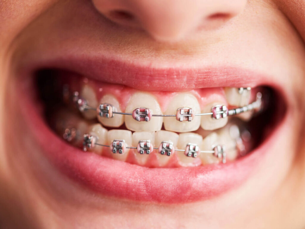 How Much Do Braces Cost At Riverwalk Dental Orthodontics how-much-do-braces-cost-at-riverwalk-dental-orthodontics